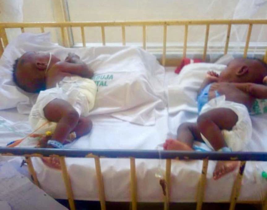 Conjoined Twins in Abuja